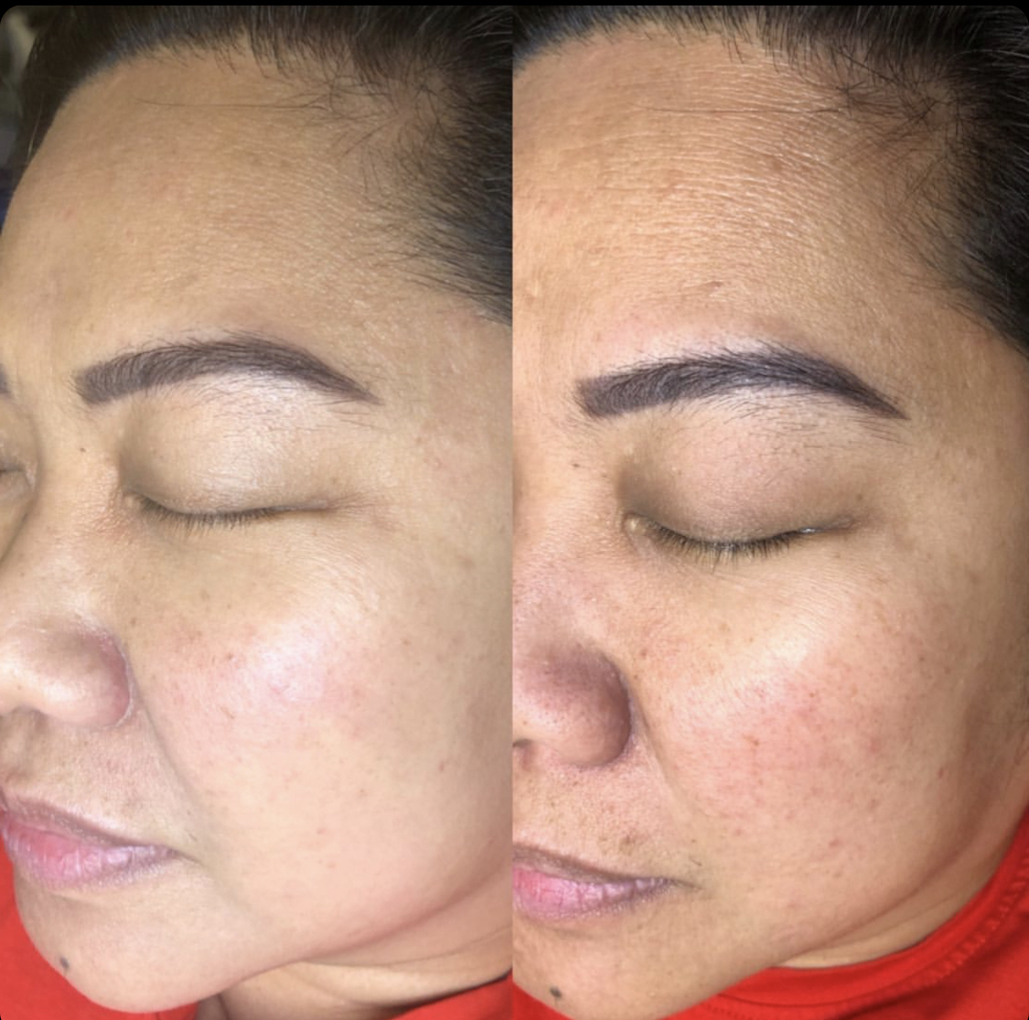 BB Glow & Microneedling - Selfie Beauty Lounge & Academy